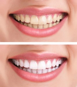 לפני ואחרי - הלבנת שיניים