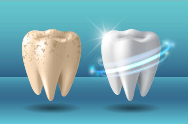 שאלות נפוצות על הלבנת שיניים – כל התשובות במקום אחד