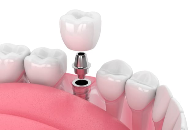 שתלים דנטליים – הפתרון המיטבי לאובדן השיניים הטבעיות
